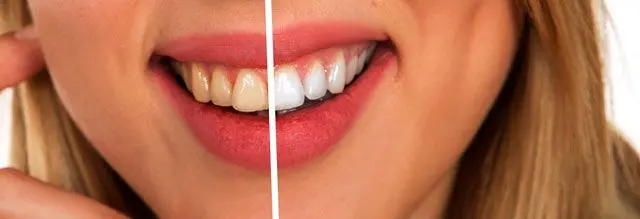 Tanden witter maken.